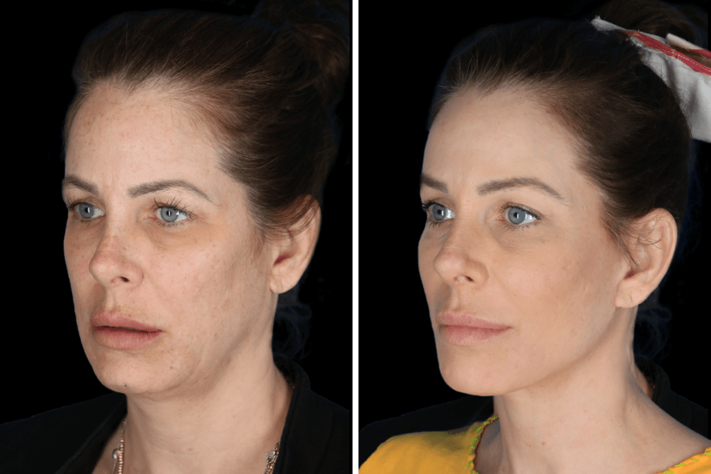 Facelift Procedure Beverly Hills CA