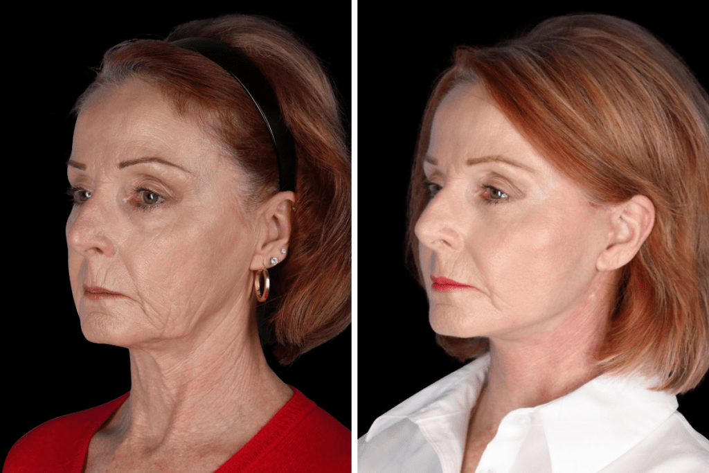 Facelift Los Angeles CA