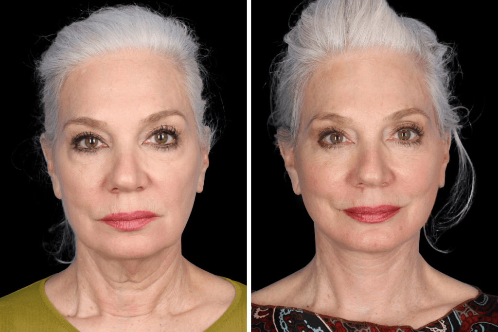 Revision Facelift Procedure Beverly Hills CA