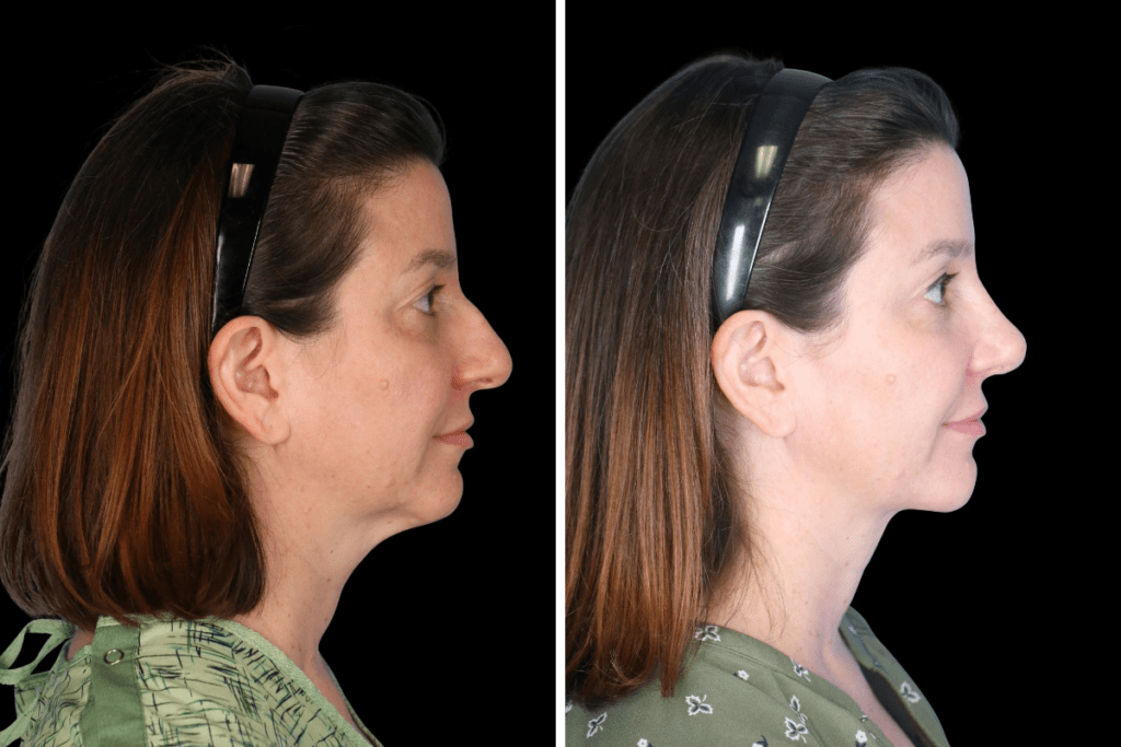 Rhinoplasty Procedure Beverly Hills CA