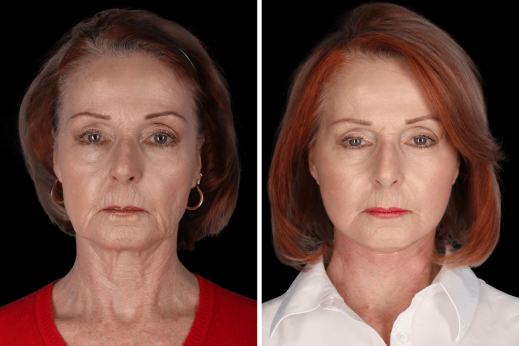 Revision Facelift Surgery Beverly Hills CA