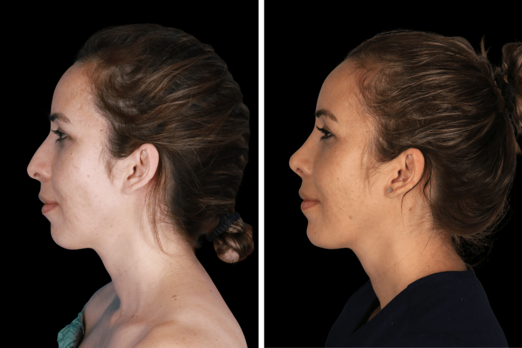 Rhinoplasty Beverly Hills CA