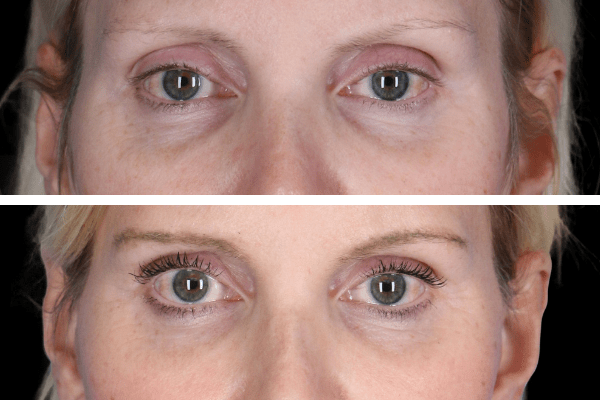 Eyelid Lift Procedure Beverly Hills CA