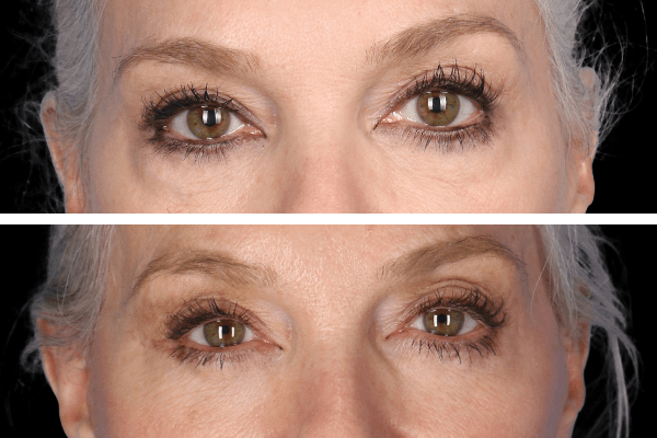 Blepharoplasty Beverly Hills CA