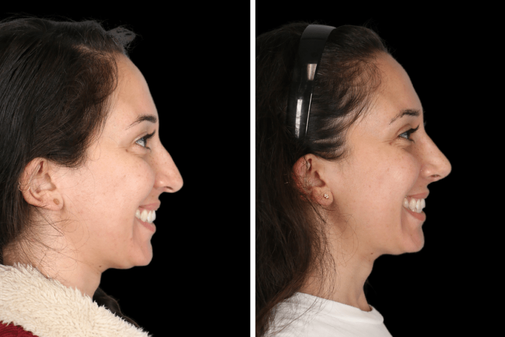 Rhinoplasty Surgery Beverly Hills CA