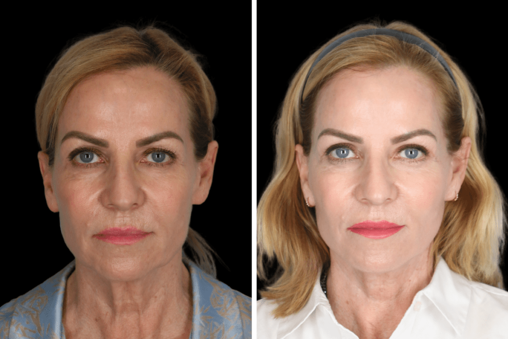 Deep Plane Facelift Surgery Beverly Hills CA