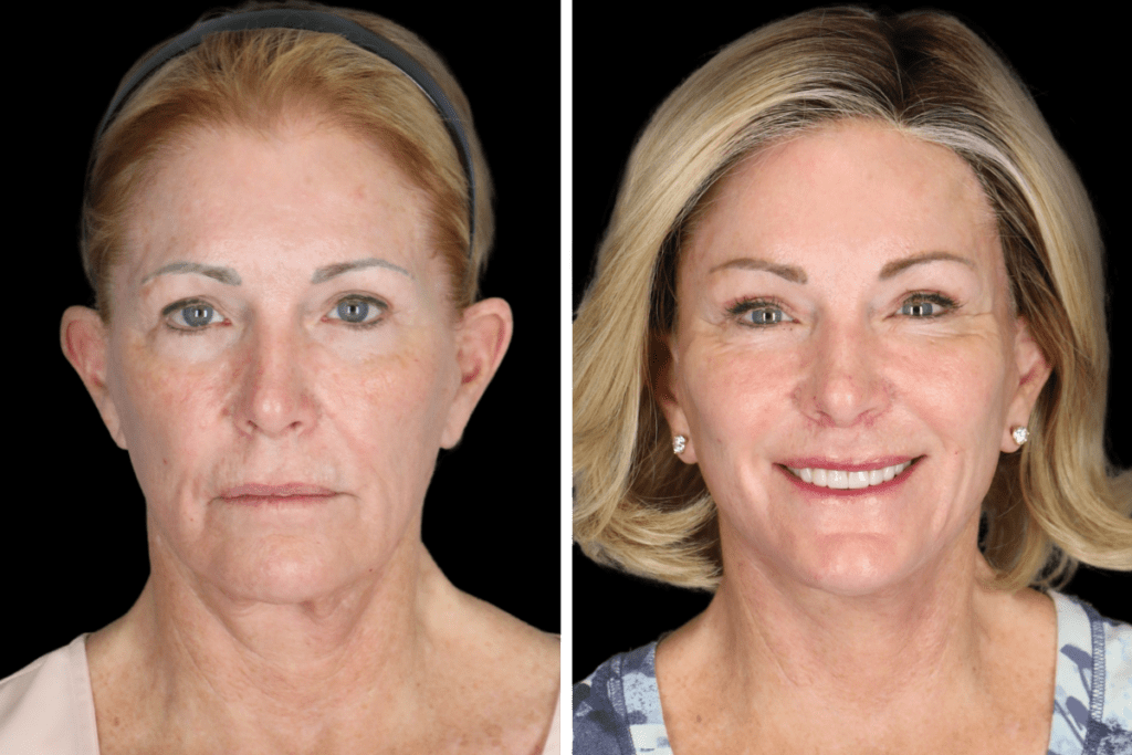 Revision Facelift Beverly Hills CA