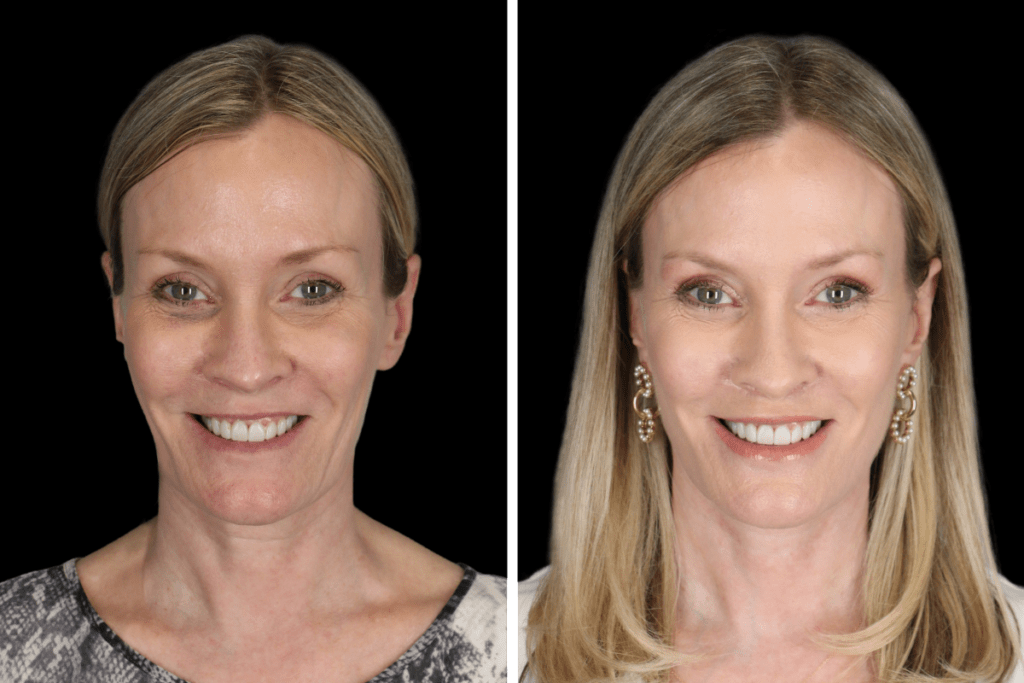 Deep Plane Facelift Procedure Beverly Hills CA